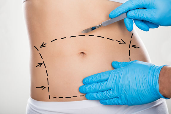 Abdominoplastik Bingen